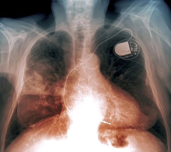Heart and lung disease, X-ray C018  /  0500