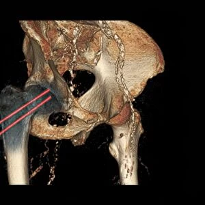 Hip fracture reduction, 3D CT scan
