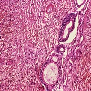 Ovarian cancer, light micrograph C015 / 7103
