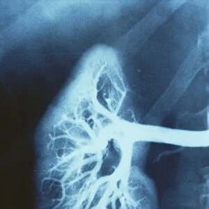 Renal blood vessels, X-ray