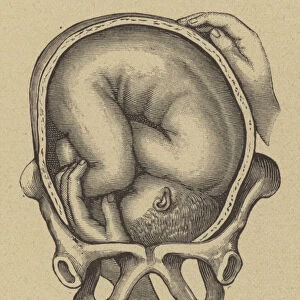 Podalic version during childbirth (engraving)